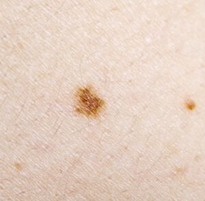 What does skin cancer look like
